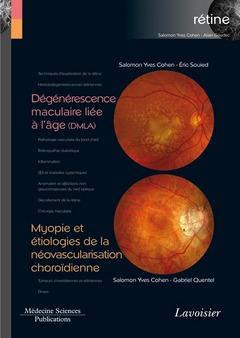 DEGENERESCENCE MACULAIRE LIEE A L'AGE (DMLA) / MYOPIE ET ETIOLOGIES DE LA NEOVASCULARISATION CHOROID