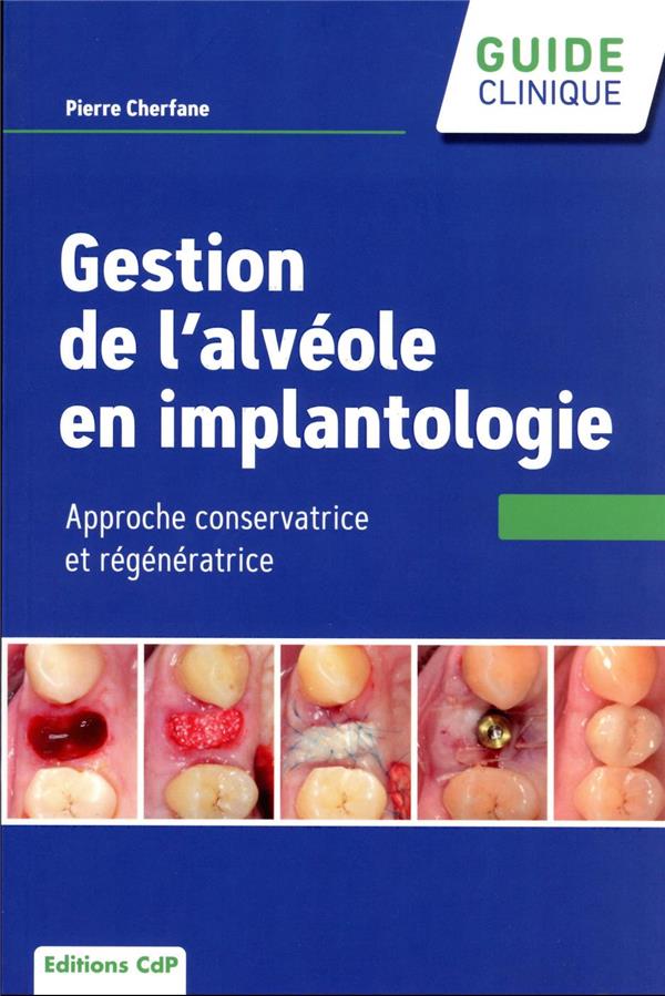 GESTION DE L'ALVEOLE EN IMPLANTOLOGIE - APPROCHE CONSERVATRICE ET REGENERATRICE