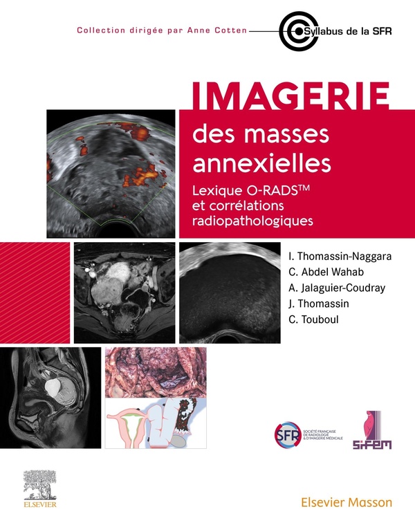 IMAGERIE DES MASSES ANNEXIELLES - LEXIQUE O-RADS ET CORRELATIONS RADIOPATHOLOGIQUES