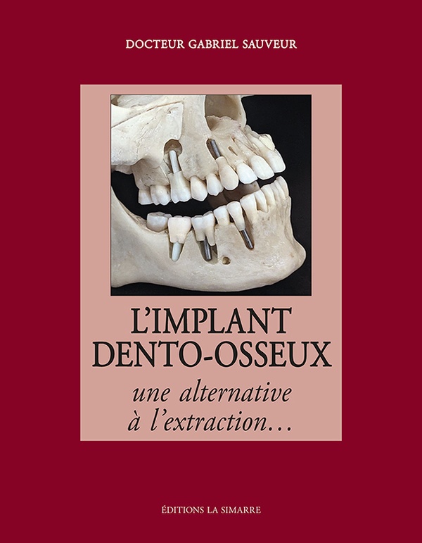 L'IMPLANT DENTO-OSSEUX : UNE ALTERNATIVE A L'EXTRACTION