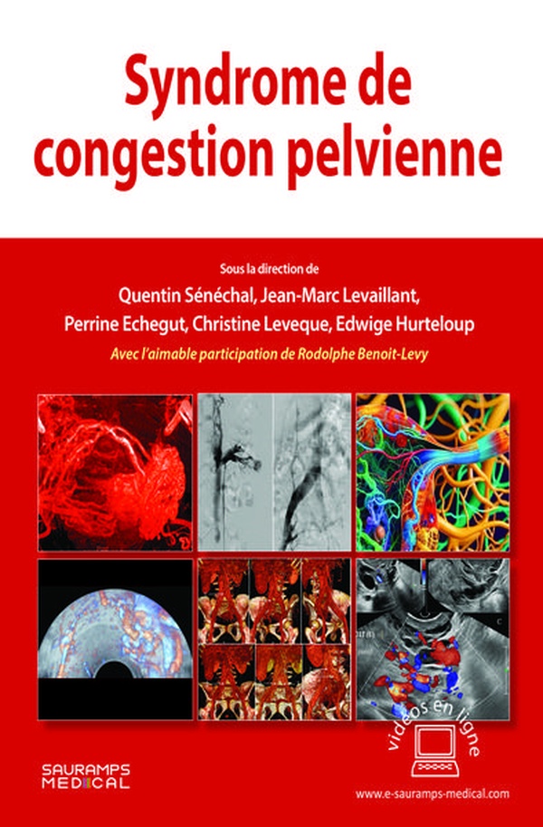 SYNDROME DE CONGESTION PELVIENNE